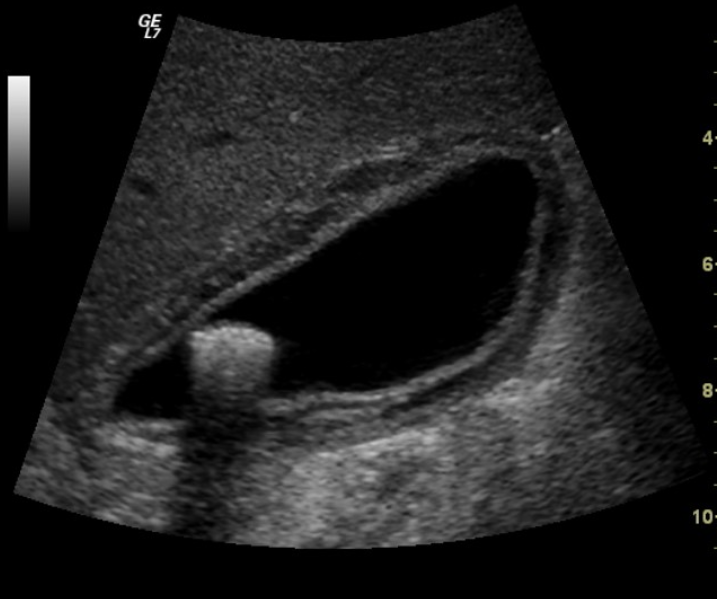 <ul><li><p>occurs at interfaces that reflect and/or absorb a significant portion of the U/S beam </p></li><li><p>common with mineral interfaces (bones, calculi, foreign bodies)</p></li></ul><p></p>