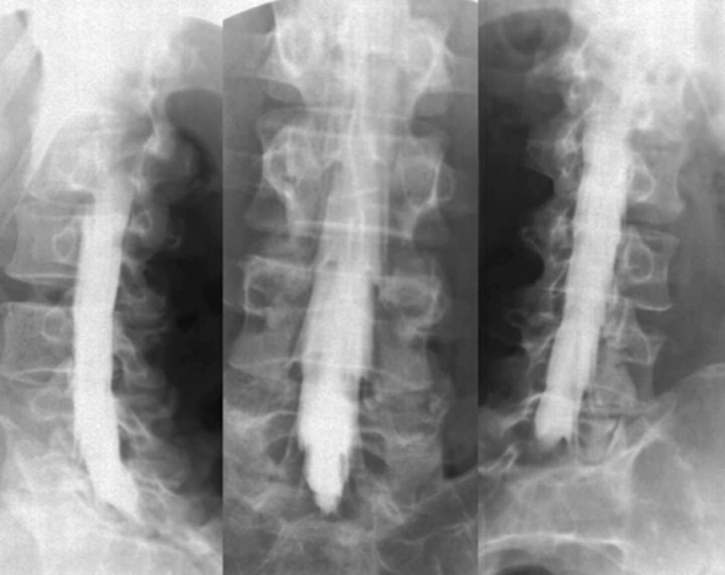 <p>- An image made with an injection of contrast medium into the subarachnoid space to examine the spinal cord and nerve roots</p>