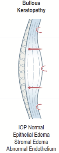 <p>The posterior curvature is affected, anterior curvature is typically not affected due to interweaving of lamellae resisting expansion. </p>