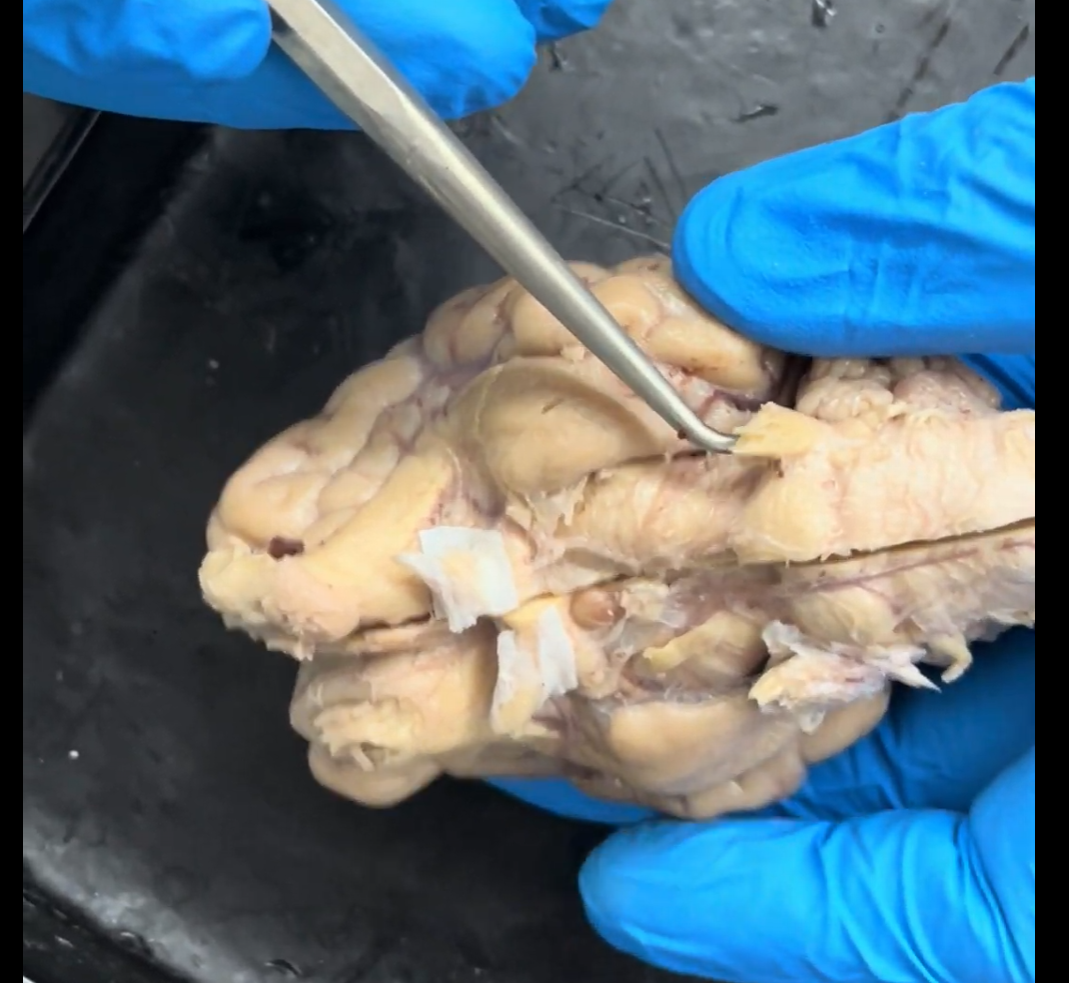 <p>Name the part of the brain being lifted by the probe.</p>