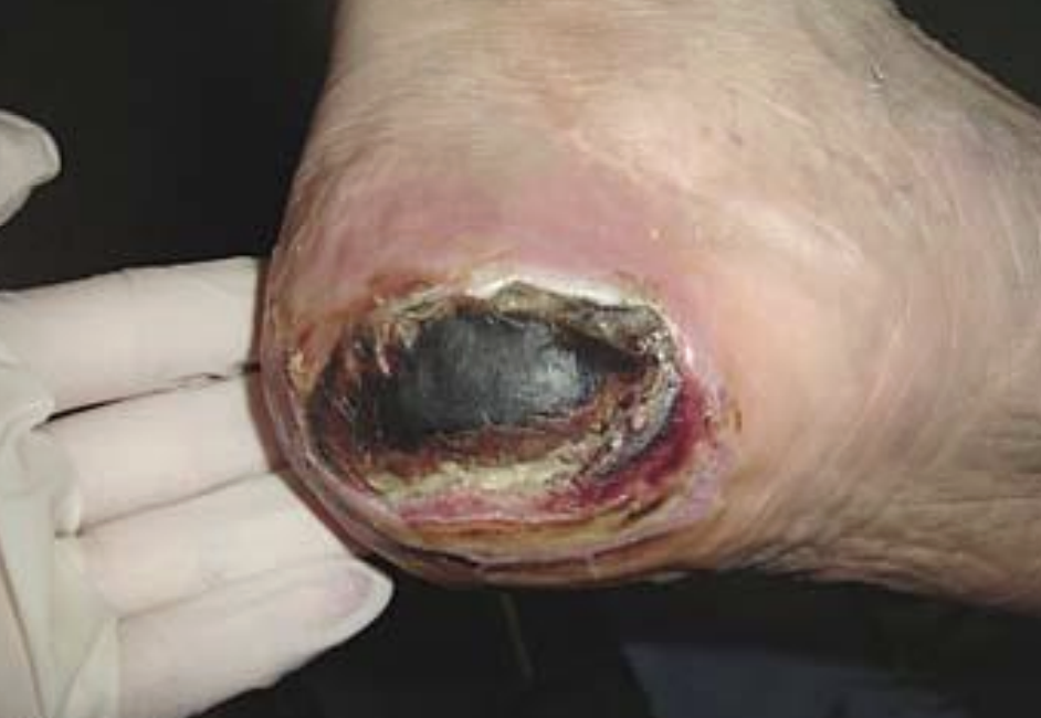 <p>pressure injury stage</p>