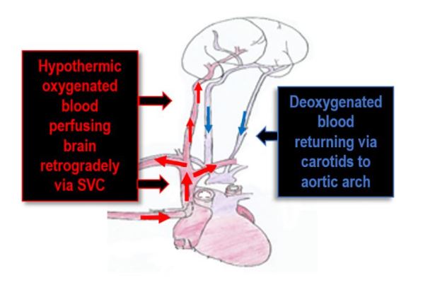 <ul><li><p>Hypothermic oxygenated blood perfusing brain retrogradely via SVC</p></li><li><p>deoxygenated blood returning via carotids to aortic arch</p></li></ul><p></p>