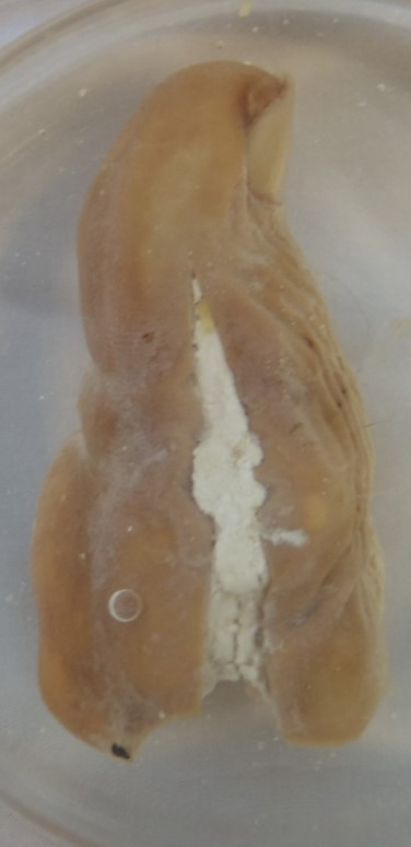 <ul><li><p>e<span>xcess uric acid production causes a mass-like deposit in the joints, which then crystallize (tophi) and lead to an </span><strong>acute inflammatory process</strong></p></li><li><p><strong>symptoms</strong><span> are localized pain, erythema, swelling, and heat due to acute inflammation</span></p></li></ul><p></p>