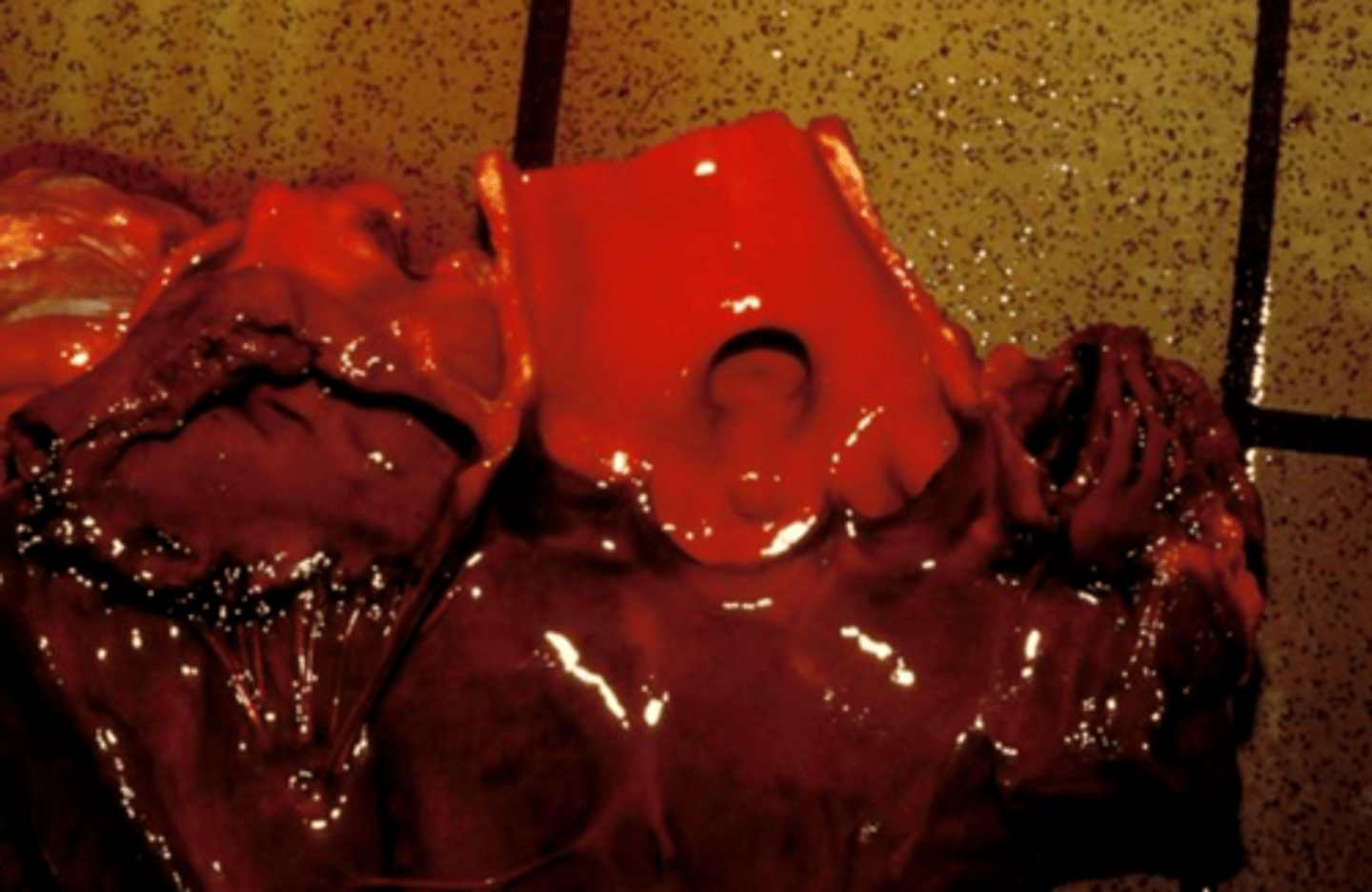 <p>what is causing his deep red pigment on this aorta?</p>