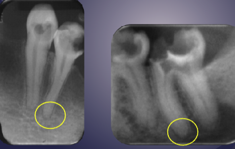 <ol><li><p>widened PDL space</p></li><li><p>loss/thickening of lamina dura (radiopaque line that’s normally around the roots)</p></li></ol><p></p>