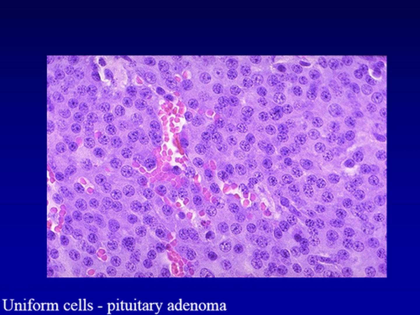 <p>histology of _______ _________</p><p>-uniform, polygonal cells arranged in thin cords and ribbons; monotonous appearance of small round cells</p><p>-see acidophils, basophils, and chromophobes</p>