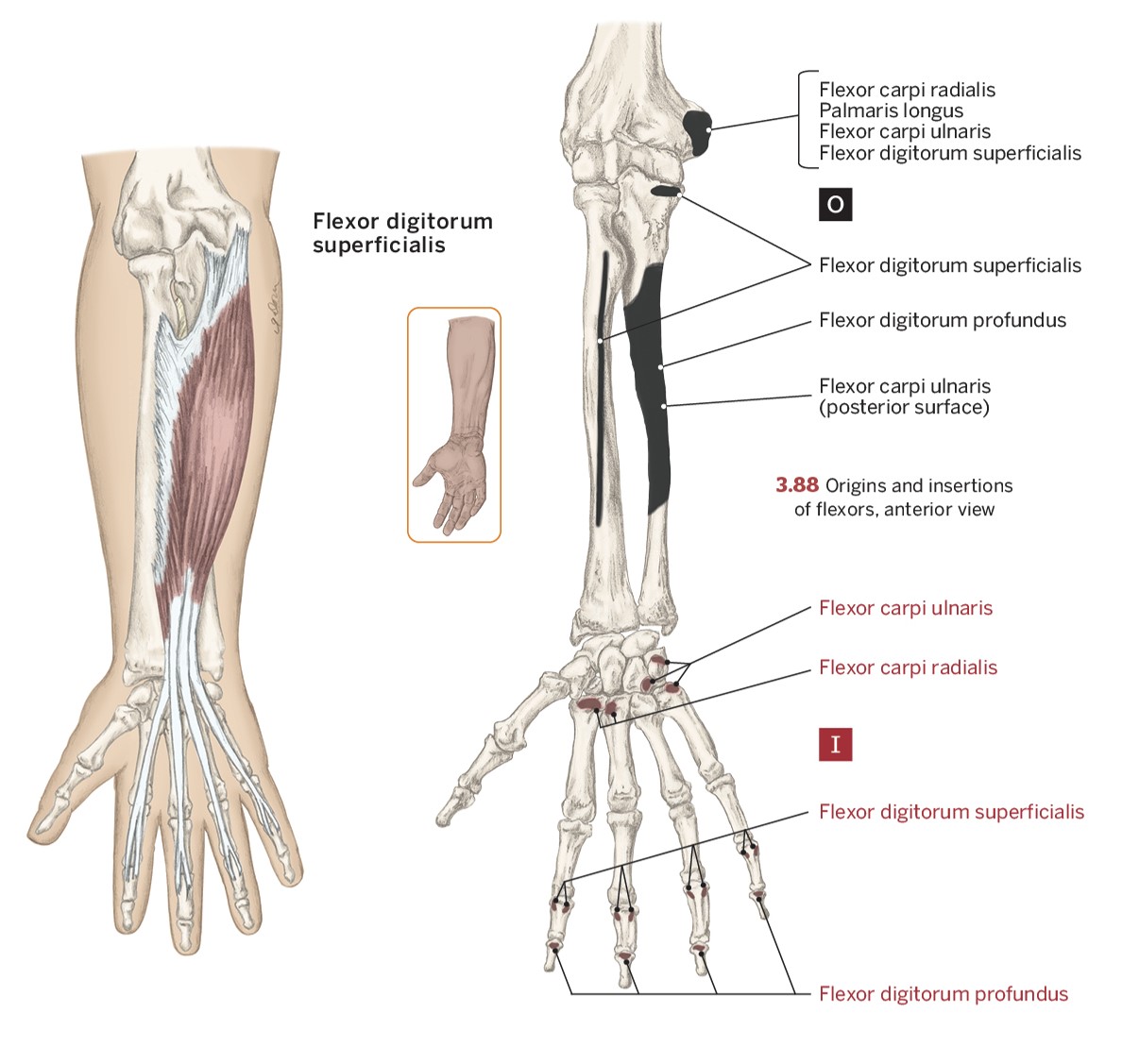 <p>O- Medial Epicondyle of the humerus</p><p>I- 2nd to 5th middle phalanges (crosses anterior to the joint)</p><p>A- Flexion of 2nd to 5th metacarpophalangeal &amp; proximal interphalangeal joint</p>