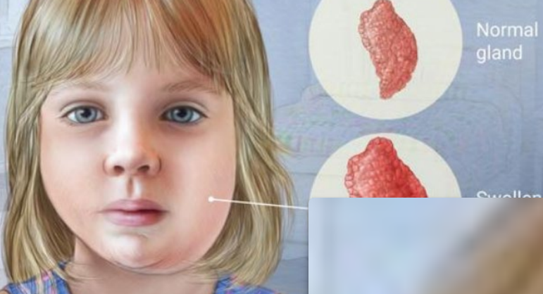 <p>viral infection that swells the salivary glands</p>