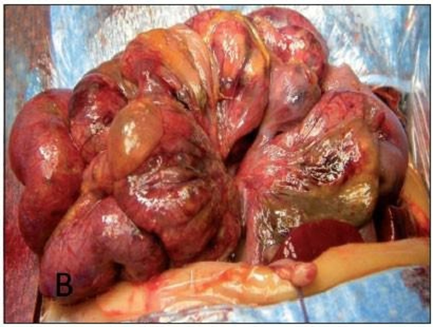 <p>A serious intestinal condition in preterm infants that can lead to bowel ischemia and septicemia.</p>