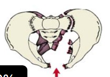 <p>Pelvic Fracture</p>