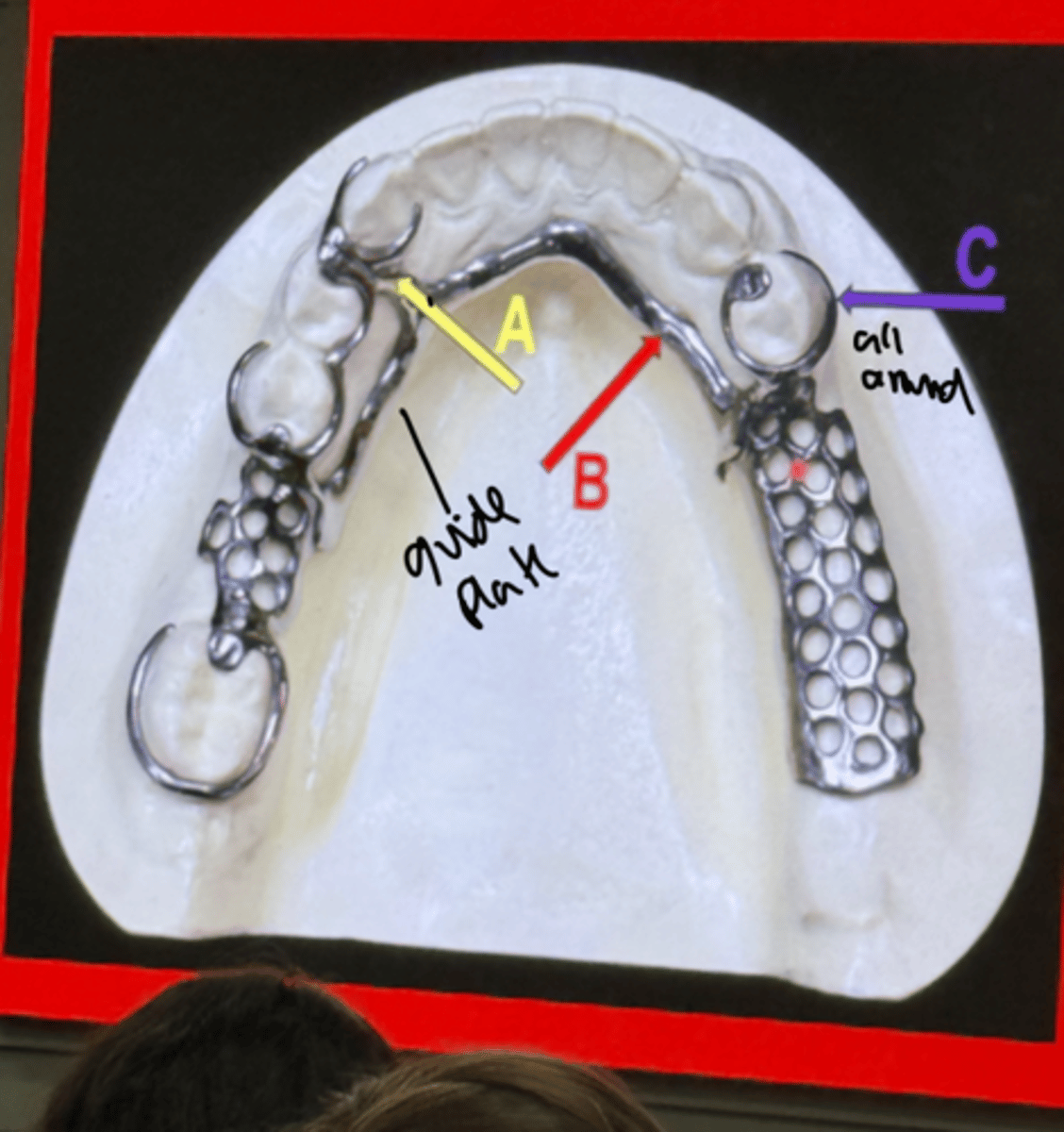 <p>minor conector</p><p>class II mod I</p><p>lingual bar major connector</p><p>retentive arm</p>