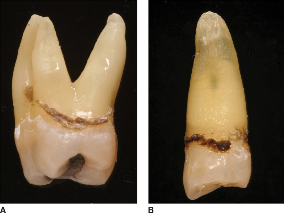 <p>Subgingival calculus</p>