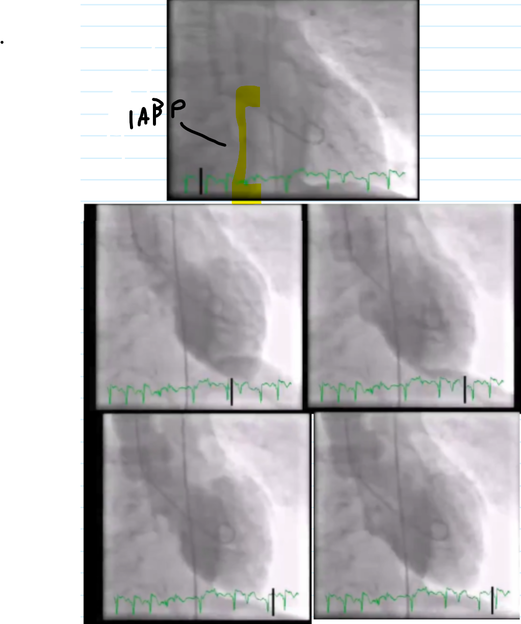 <ul><li><p>Projection (RAO/LAO)</p></li><li><p>Wall motion assessment</p></li><li><p>Estimated ejection fraction</p></li><li><p>Any valvular disease visualized</p></li></ul><p></p>