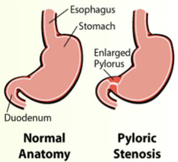 <p>constriction of the pyloric sphincter obstructing the gastric outlet, develops first few weeks of life-familial predisposition</p><p>signs: projectile vomiting (after feeding), hungry immediately after feeding, weight loss, FTT, dehydration, constipation, pyloric olive</p><p>treatment: pyloromyotomy, small frequent feedings in beginning</p>