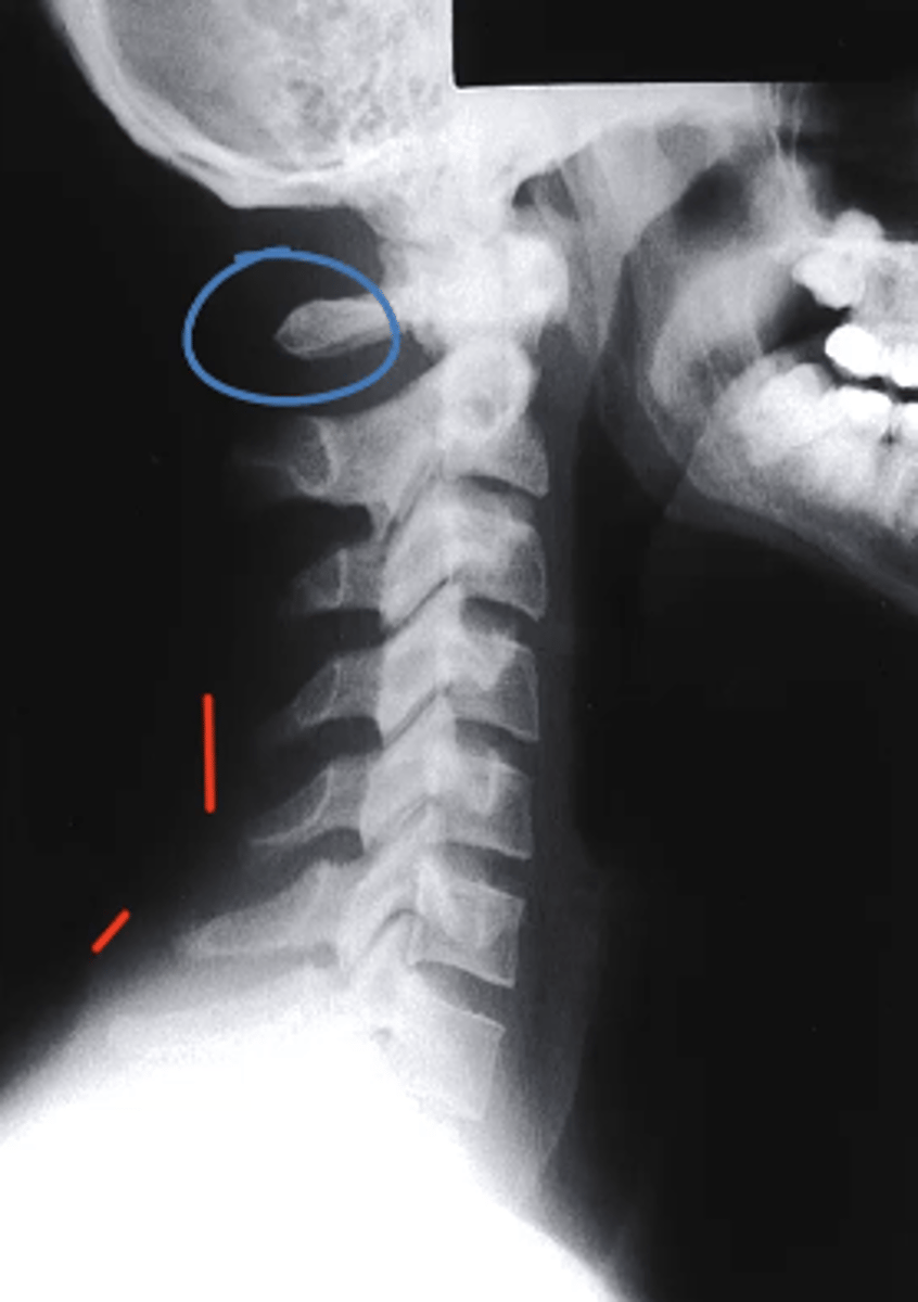 <p>What structure is circled in blue?</p><p>a. Dens</p><p>b. Spinous Process of C2</p><p>c. Spinous Process of C3</p><p>d. Posterior Arch of C1</p>