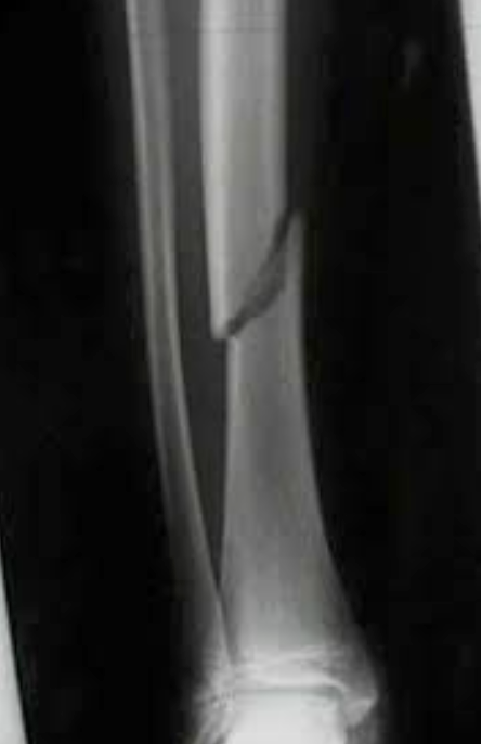 <p><span style="font-family: &quot;Trebuchet MS&quot;, sans-serif">Fracture occurs sloped up/down at an angle.</span></p>
