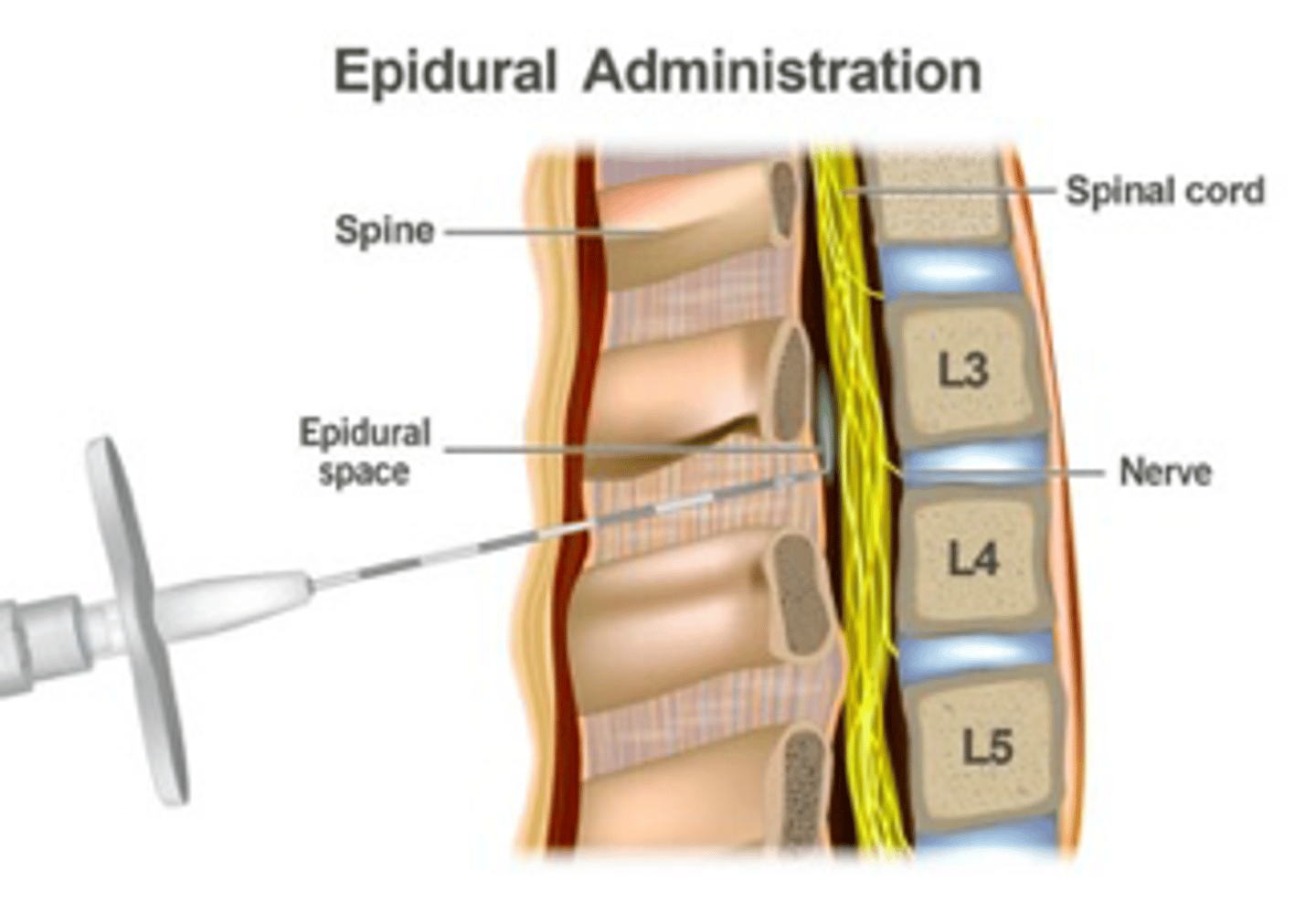 <p>•NSAIDs</p><p>•Physical therapy</p><p>•Weight loss</p><p>•Bracing</p><p>•Steroid injections (epidural and transforaminal)</p>