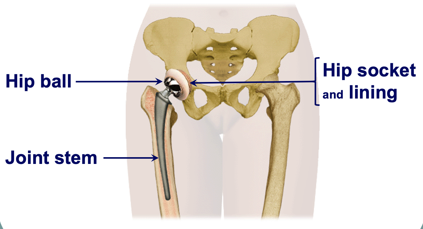 <p>(R) hip prosthesis </p>