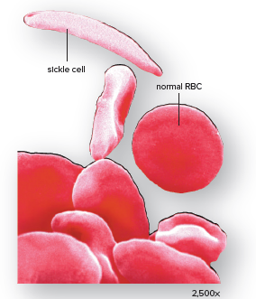 Sickle-cell disease.
