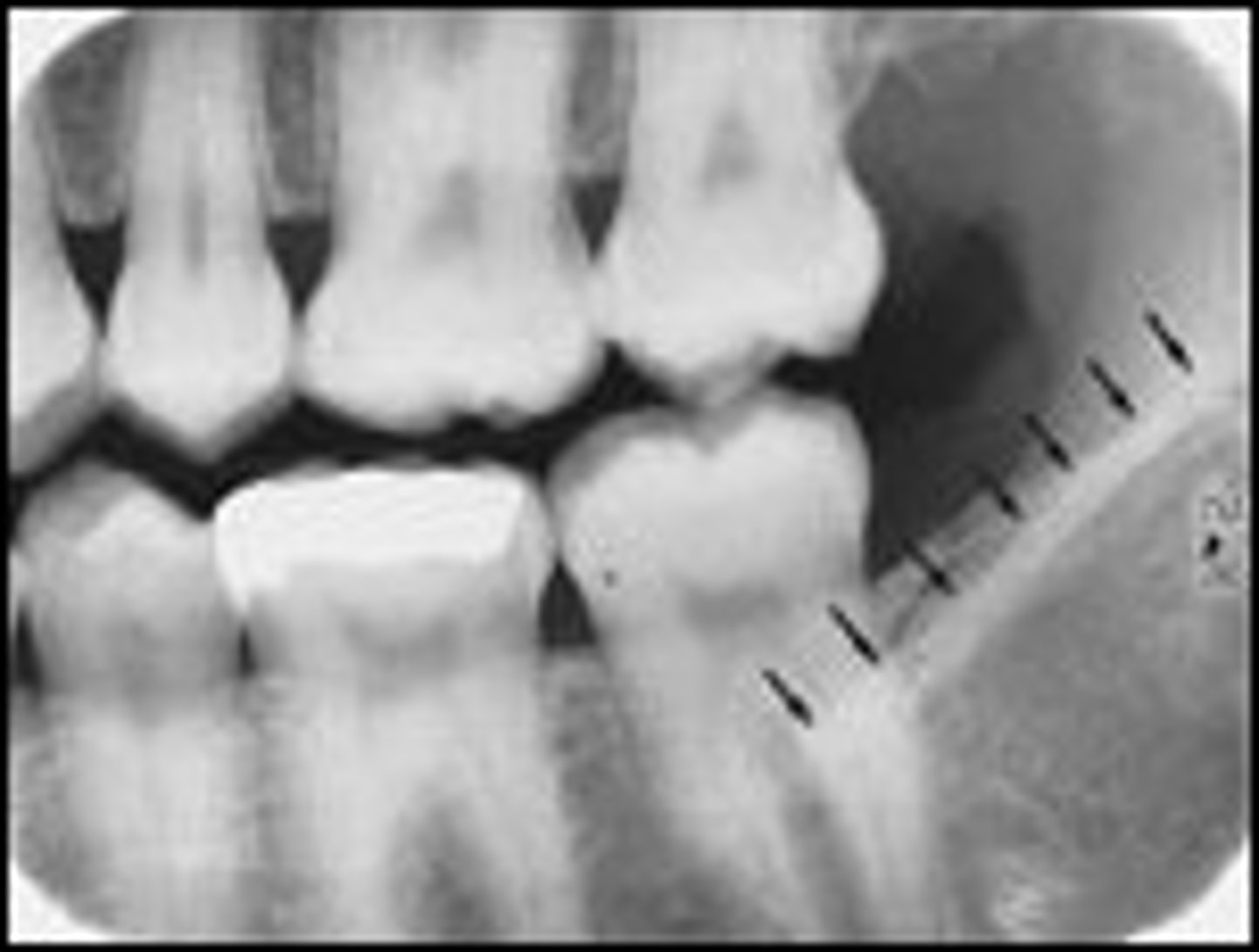 <p>What is the radiopaque structure seen here?</p>