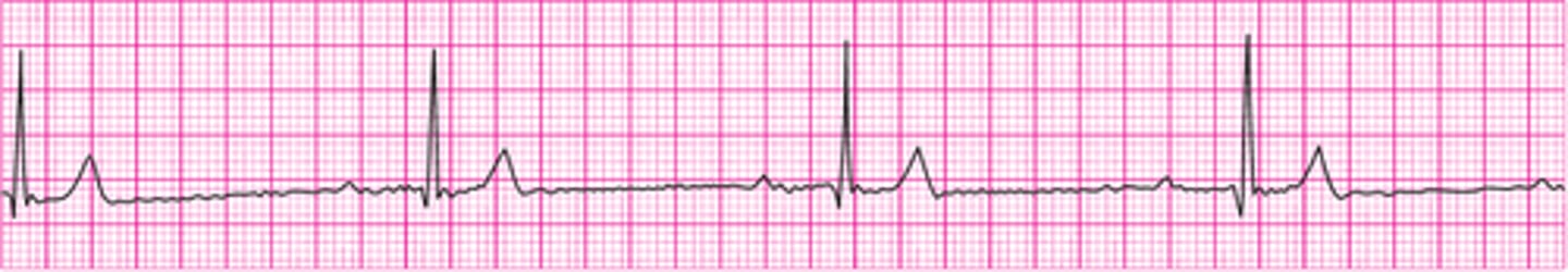 <p>Sinus bradycardia - version 2</p>
