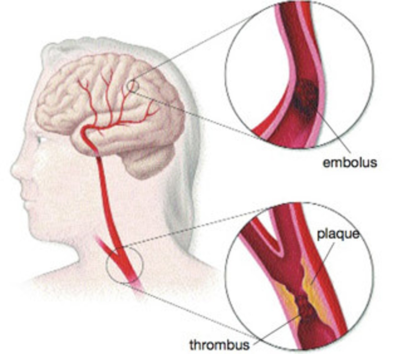 <p>/strəʊk/ danh từ</p><p>đột quỵ, sự va chạm, cú đánh</p><p>She suffered a stroke due to high blood pressure.</p><p>attack, seizure, blow</p><p>stroked (v), stroking (n)</p>