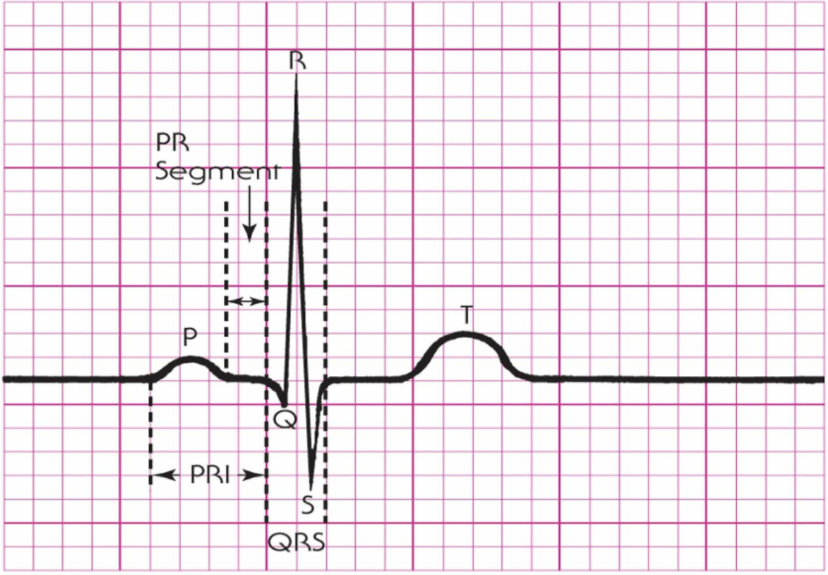 <p>It is usually located immediately in front of the QRS complex.</p>