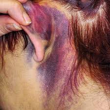 <p>Es una contusión detrás de la oreja que indica una posible fractura de la base del cráneo, específicamente de la dosa posterior</p>