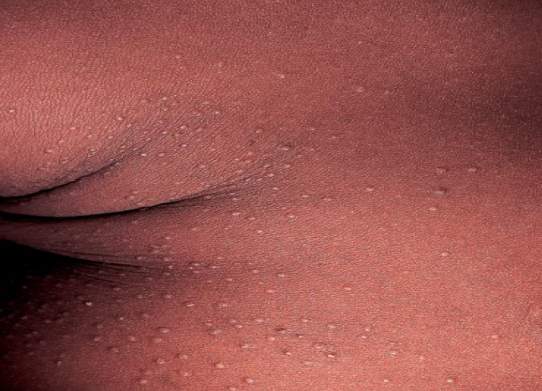 <p>what lesion is depicted</p>