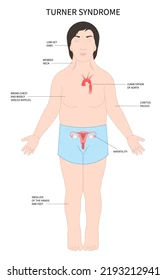 <ul><li><p>No menstrual cycle & failed ovaries (thus, are sterile)</p></li><li><p>Limited breast development & wide chest</p></li><li><p>Short, webbed neck & pre-pubescent appearance</p></li></ul><p></p>