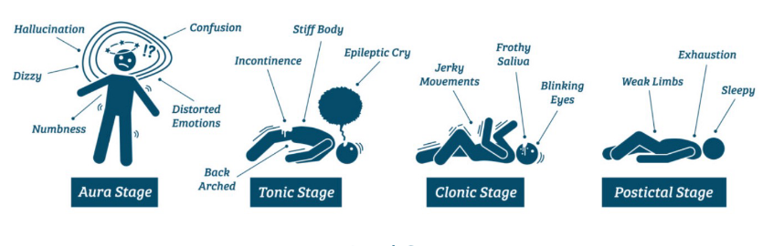<ul><li><p>Prodromal phase</p></li><li><p>Aural phase</p></li><li><p>Ictal phase</p><ul><li><p>Tonic phase</p></li><li><p>Clonic phase</p></li></ul></li><li><p>Postictal phase</p><ul><li><p>Can last hours to days</p></li></ul></li></ul><p></p>