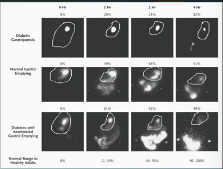 <p><strong>Gastroparesis: Diagnosis</strong></p><p>-Exclude mechanical obstruction</p><ul><li><p>Upper __________</p></li><li><p>CT or MRI enterography → if unavailable, then barium follow through </p></li></ul><p>-Assess gastric ________</p><ul><li><p>Gastric scintigraphy → ingestion of meal followed by ________ immediately after then at 1, 2, and 4 hours </p></li><li><p>Delayed emptying defined as gastric _________ &gt; __% at 4 hours and/or __% at 2 hours </p></li></ul><p></p>