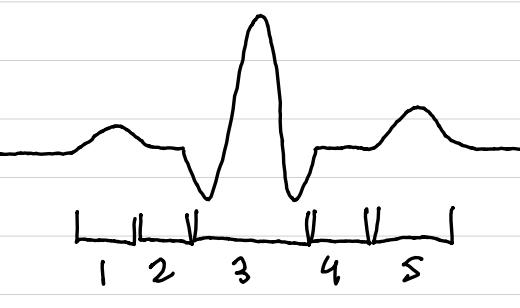 <p>[3]</p><p>jagged line on ECG that represents ventricular depolarization</p>