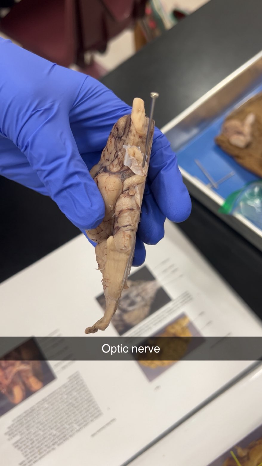 <p>optic nerves</p>
