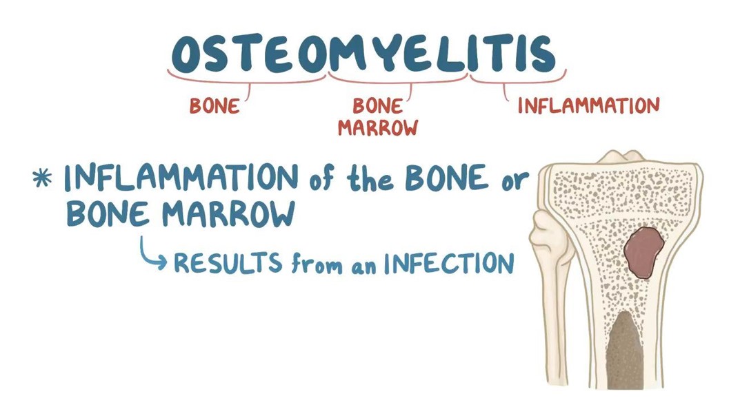 <p><strong><span>Osteomyelitis</span></strong></p>