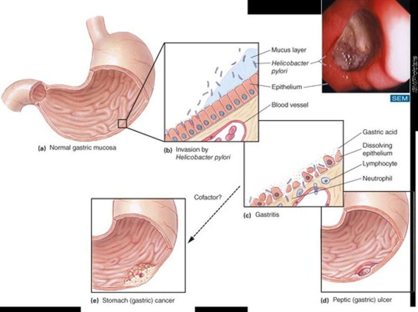 <p>Helicobacter pylori</p>