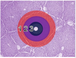 <ul><li><p>Periportal</p></li><li><p>Midzonal</p></li><li><p>Centrolobular (surrounds central vein)</p></li></ul><p></p>