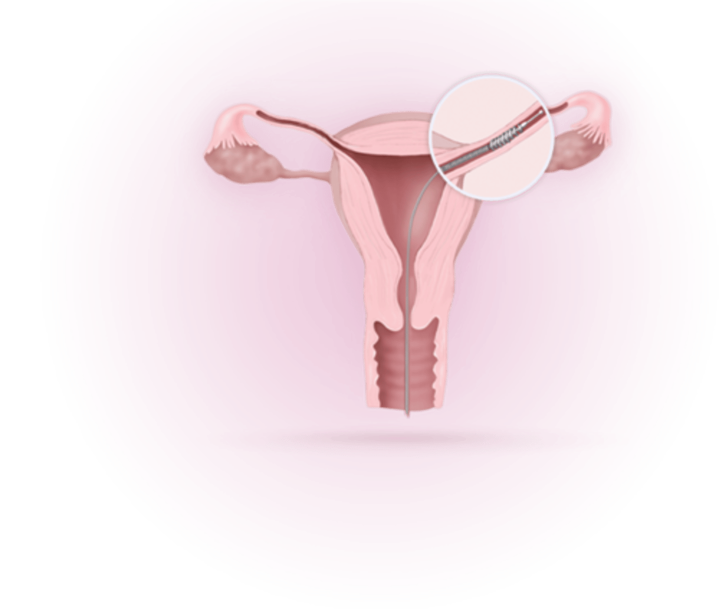 <p>Results in the coil producing scar tissue in the uterine tubes that prevents the release of eggs</p><p>-Permanent method</p>