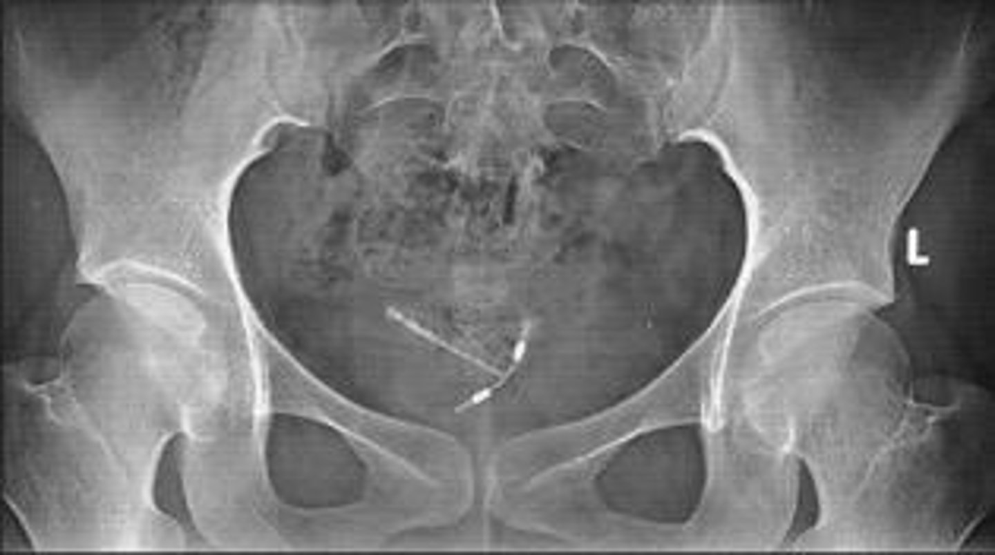 <p>Intrauterine device preventing conception.</p>