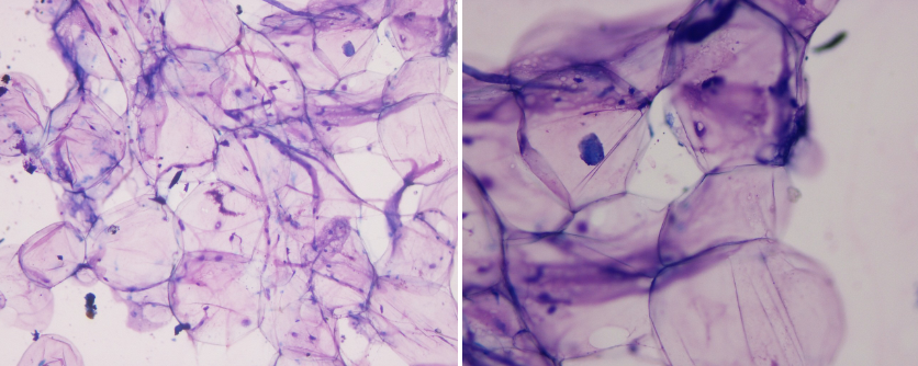 <p>What is your cytologic diagnosis?</p><p>A. Epidermal inclusion cyst </p><p>B. Lipoma </p><p>C. Sebaceous adenoma </p><p>D. Mast cell tumor </p>