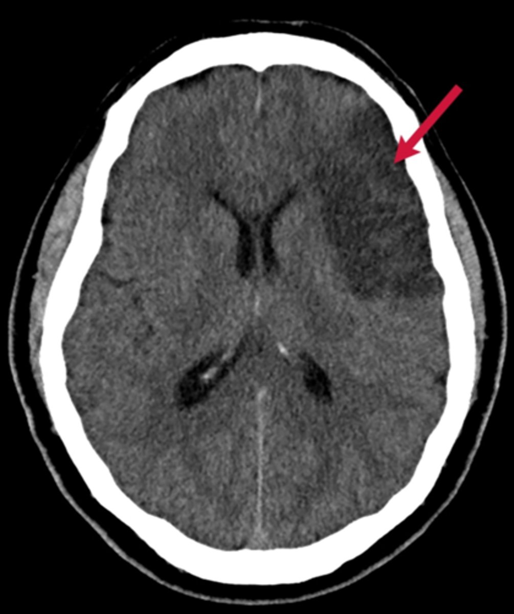 <p>stroke that occurs when the flow of blood to the brain is BLOCKED</p><p>- aspirin can help</p><p>- blockage can be from thrombocytes, embolisms</p>