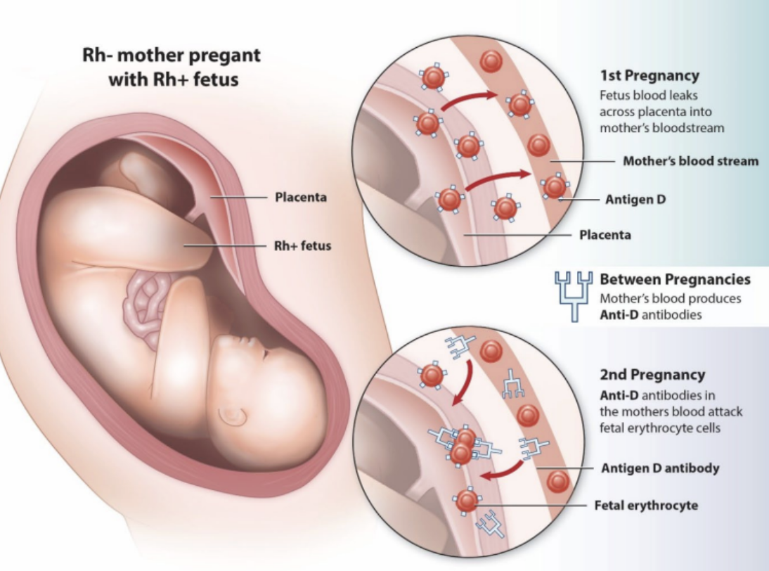 <p><strong>rh factor</strong></p><ul><li><p>hemolytic disease of the newborn (HDN)</p></li><li><p>____ fetus in an ____ mother</p><ul><li><p>agglutinination and/or hemolysis</p></li><li><p>RhoGam is a 20th week intramuscular injection</p></li></ul></li></ul><p></p>