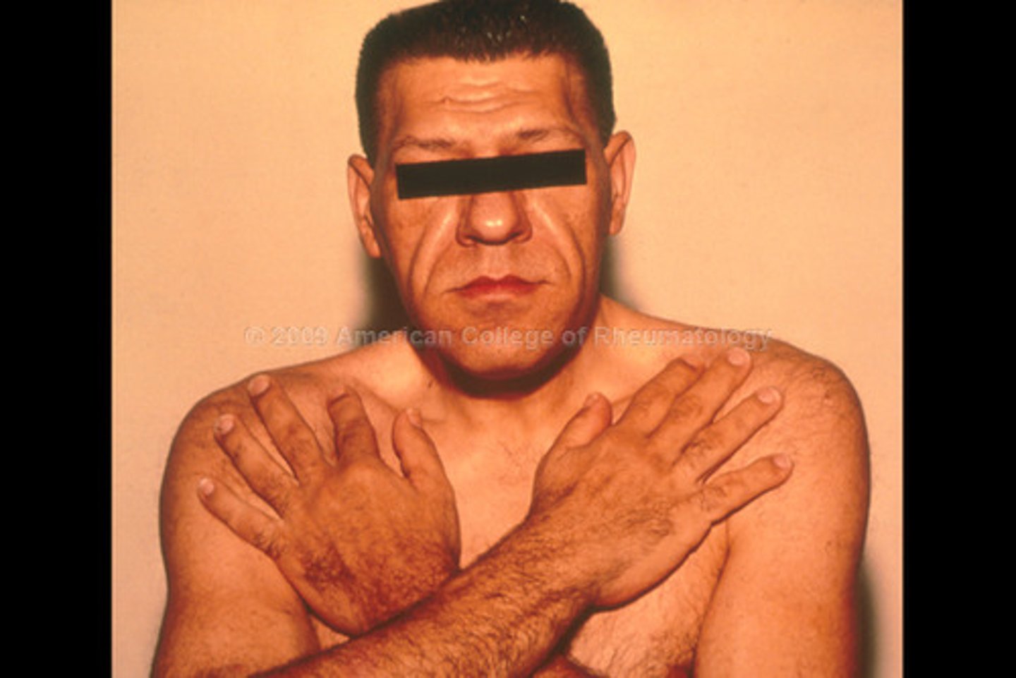 <p>Excess secretion of growth hormone, causing gigantism, acromegaly, hirsutism (excess hair growth), galactorrhea (abnormal lactation), amenorrhea, infertility, or impotence.</p>