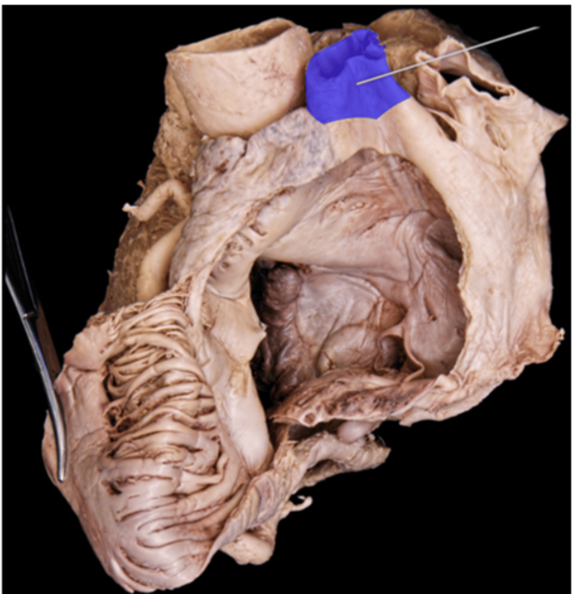 <p>superior vena cava</p>