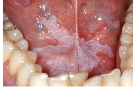 <p>-Caused by Hyperkeratosis related to chronic irritation</p><p>-Small % are <strong>dysplastic or early SCC</strong></p><p>-MC in <strong>middle aged &amp; older men</strong></p><p>-CX: White lesion on mucosa; can NOT be rubbed off; can be small</p><p>-DX: Punch biopsy</p><p>-TX: excision</p>