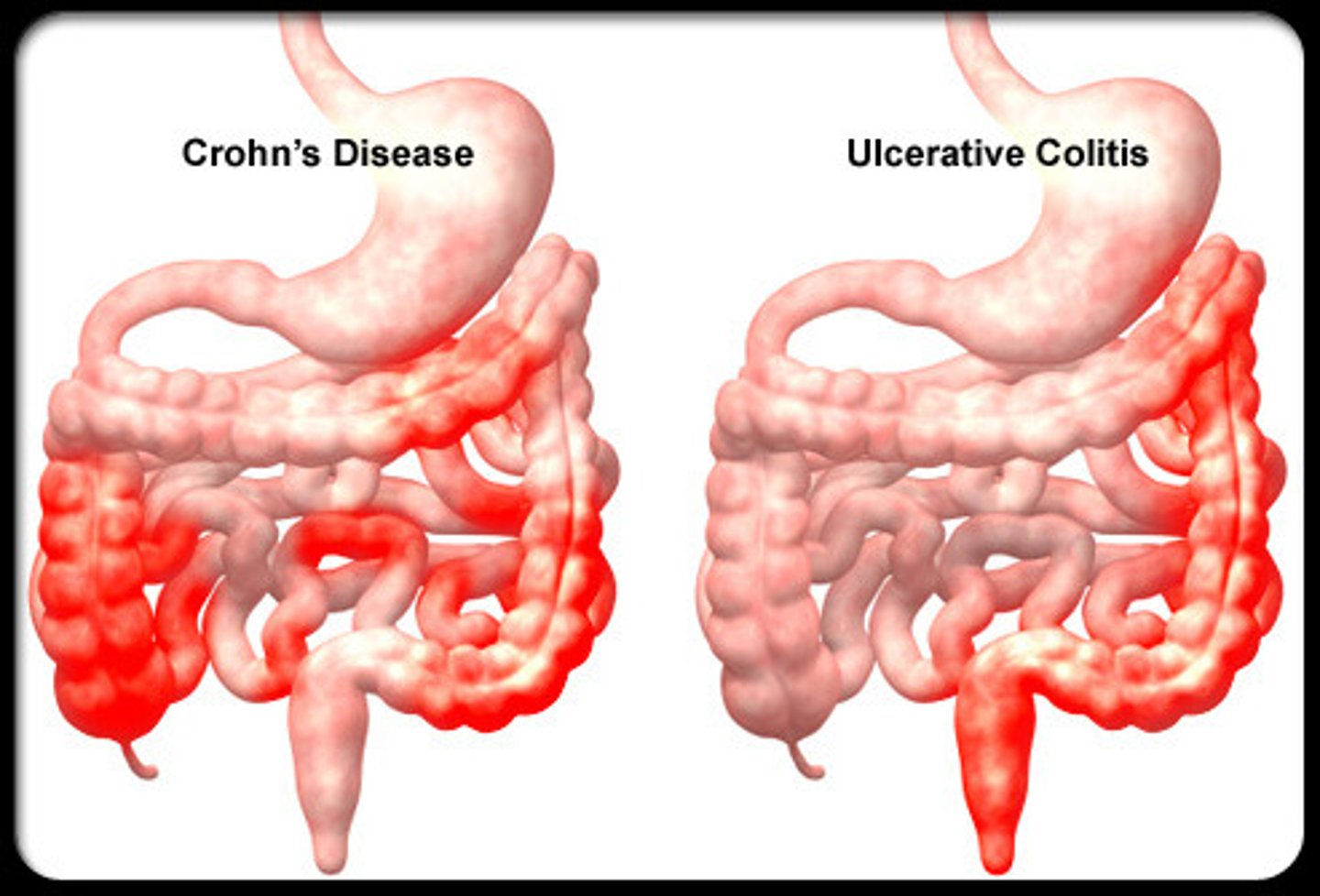 <p>inflammation of the colon with the formation of ulcers, which can cause bloody diarrhea</p>