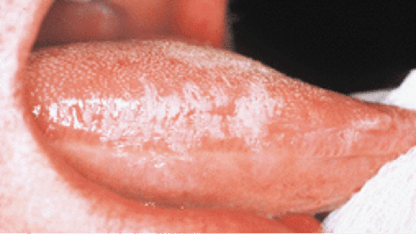 <p>a white rough patch that arises on the LATERAL tongue. Usually seen in immunocompromised and is due to EBV induced squamous cell hyperplasia. NOT pre-malignant.</p>
