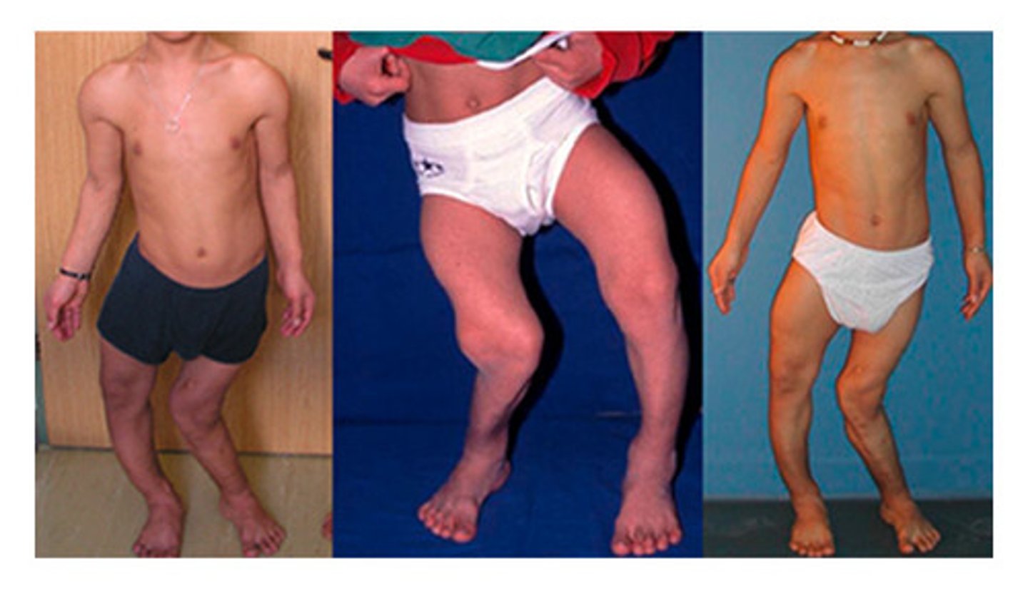 <p>pelvis rotates laterally, with the thighs moving to the other side</p>