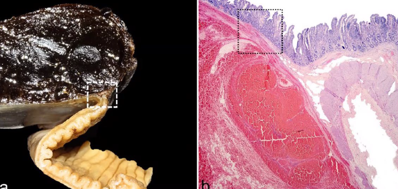 <p>Dairy cow; where does the lesion start?</p><p>A-Muscularis externa</p><p>B-Muscularis interna</p><p>B-Muscularis mucosae</p><p>C-Lamina propria</p>