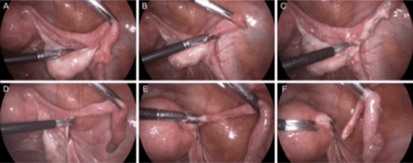 <p>laparoscopic salpingectomy</p>